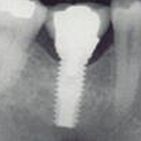 Ce este un implant dentar?